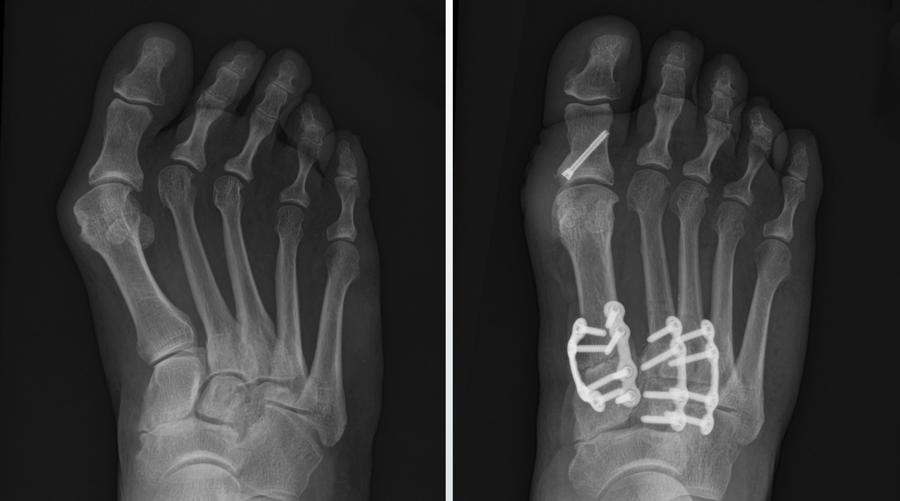 A before and after X-ray of the Adductoplasty procedure to correct mid-foot deformities.