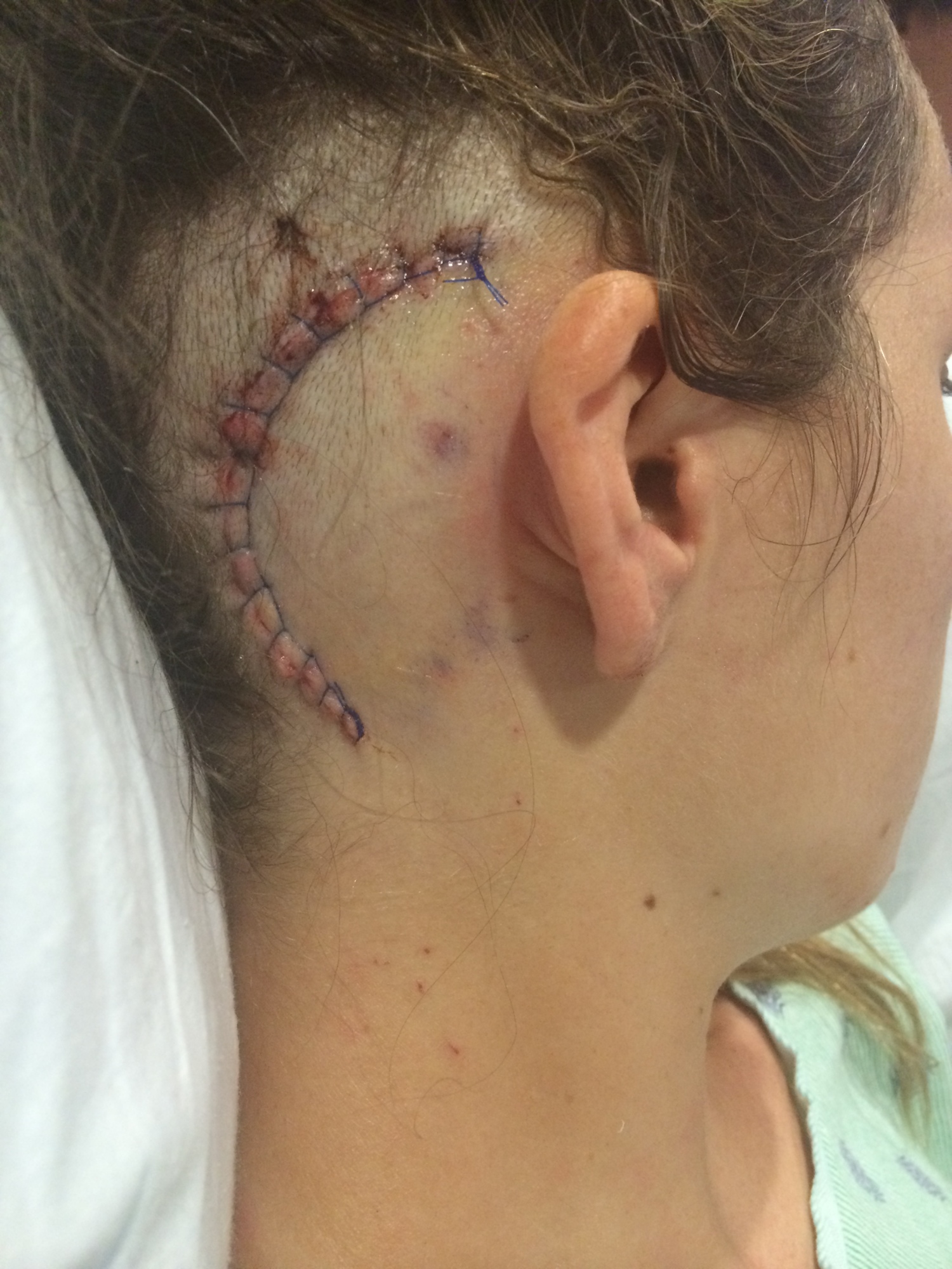 In June of 2014, doctors found a golf-ball sized, benign, brain tumor on her eighth cranial nerve. They used a curved incision to remove 98% of the tumor.