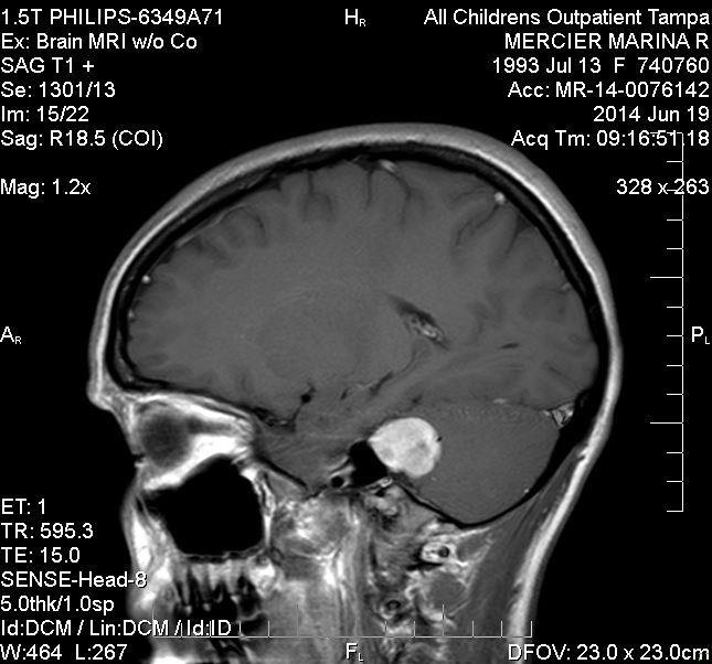 In June of 2014, doctors found a golf-ball sized, benign, brain tumor on her eighth cranial nerve.