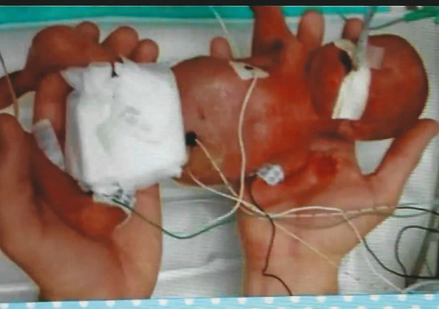 Tori was born at 24 weeks gestation, weighing 1.7 pounds.