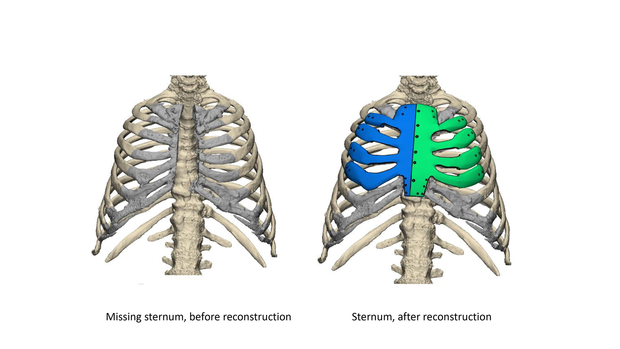 These Mayo Clinic images show how a missing sternum can be reconstructed using a replacement part that has been 3D printed.